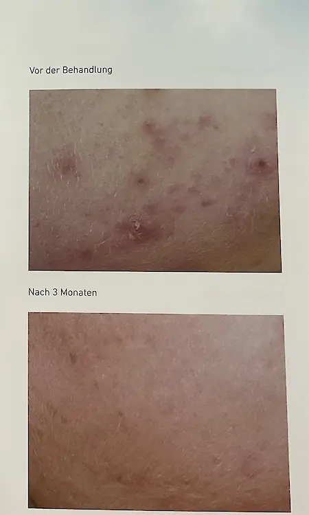 Vorher-Nachher Vergleich bei Akne und Hautunreinheiten nach 3 Monaten