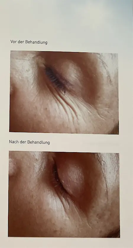 Vorher-Nachher Straffung und GlÃ¤ttung der empfindlichen Augenpartie