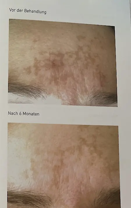 Vorher-Nachher Aufhellung von Pigmentflecken und ebenmÃ¤ssiges Hautbild nach 6 Monaten
